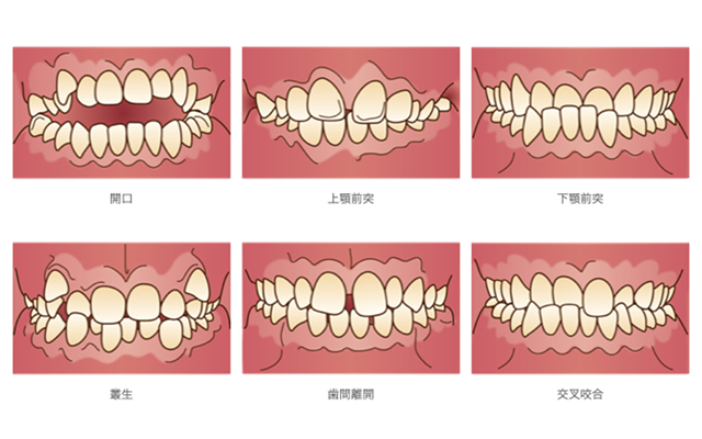 歯並びの種類イラスト